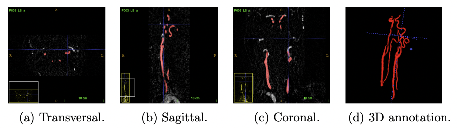 MRA(Magnetic Resonance Angiography)로 스캔한 동맥 3D 이미지.